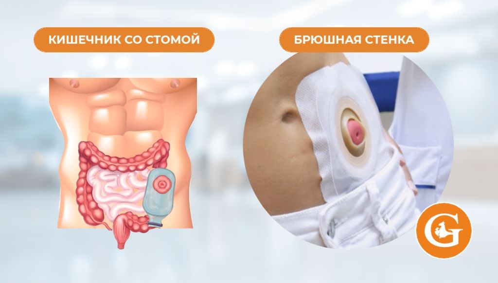 Колостомия Колостомия