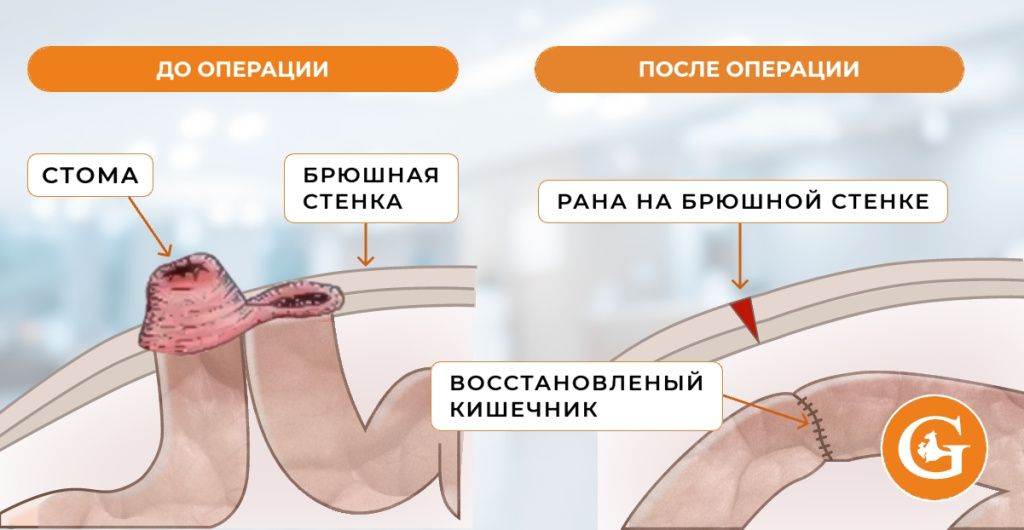 Закрытие колостомы Закрытие колостомы